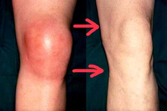 Mujer sufriendo de dolor de rodilla al levantarse