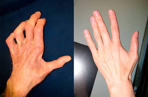 Mujer sufriendo de dolor de rodilla al levantarse