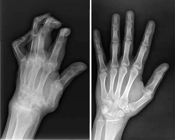 Mujer sufriendo de dolor de rodilla al levantarse